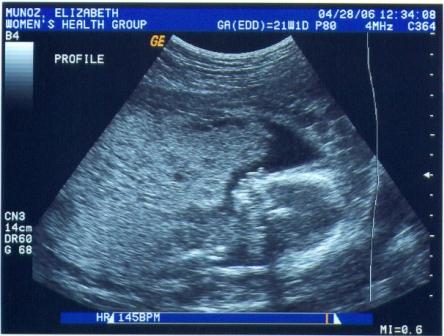 Here is my sonagram profile